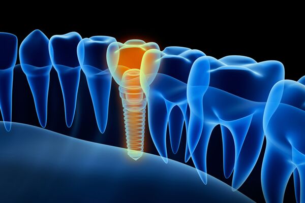 Dental Implants 1